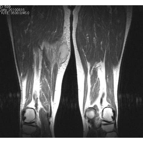 T2 Weighted Sagittal Mri Of The Thigh Showing A Heterogenous Mass In