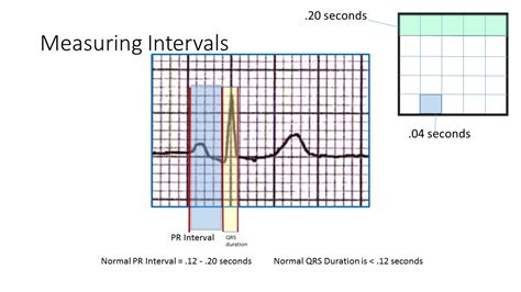 Measuring Ecg Intervals Hot Sex Picture