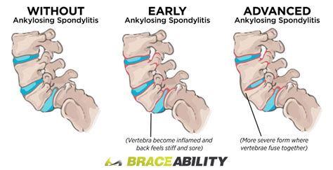 Spondylosis Spondylolysis Spondylolisthesis Motus Physical Therapy