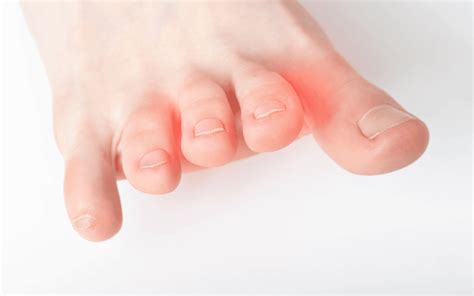 Understanding Mortons Neuroma Causes Symptoms And Treatment Options Texas Foot And Ankle