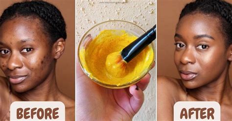 Special Besan Face Mask Recipe To Brighten Your Skin