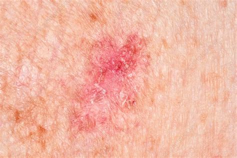 Basal Cell Carcinoma Skin Cancer Stock Image C0370914 Science