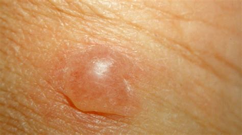 Raised Skin Bumps Pictures Types Causes And Treatment