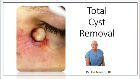Total Removal Of Sebaceous Cyst The Best Treatment Option YouTube