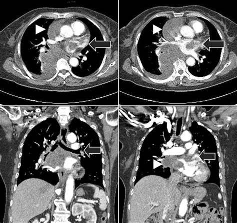 The Chest Computed Tomography Scan Shows The Mediastinal Mass