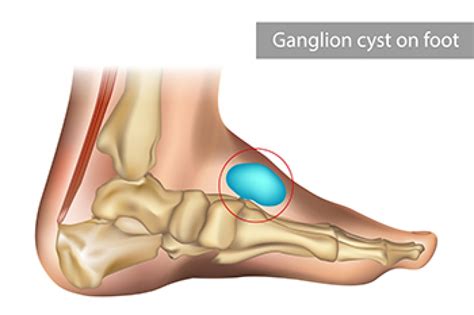What Is A Ganglion Cyst