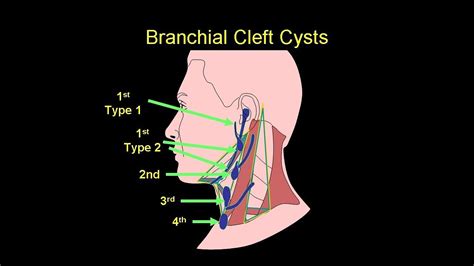Discuss The Branchial Cleft Cysts Youtube