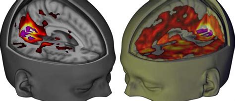 Landmark Study Reveals The Effect Of Lsd On The Brain Bbc Science