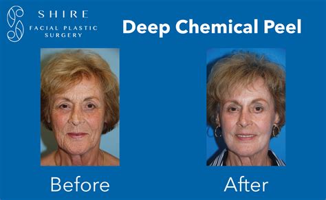 Deep Chemical Peels Before After Shire Facial Plastic Surgery