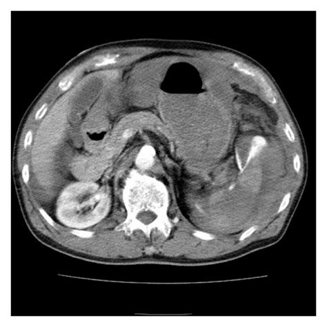 Transverse Plane Of Helical Ct Of Abdomen With Iv Contrast Shows