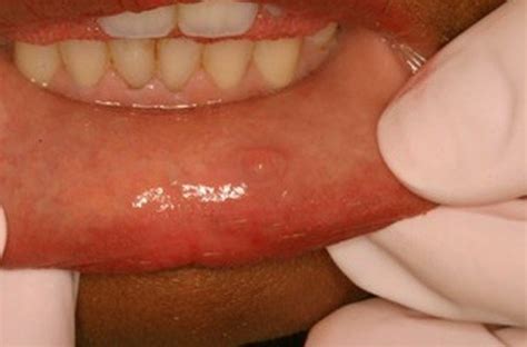 Pictures Causes Symptoms And Treatment Of Oral Mucocele Hubpages
