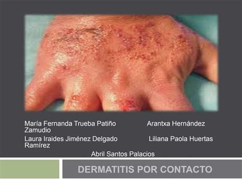 Dermatitis Por Contacto Causas Manifestaciones Y Diagnóstico Ppt