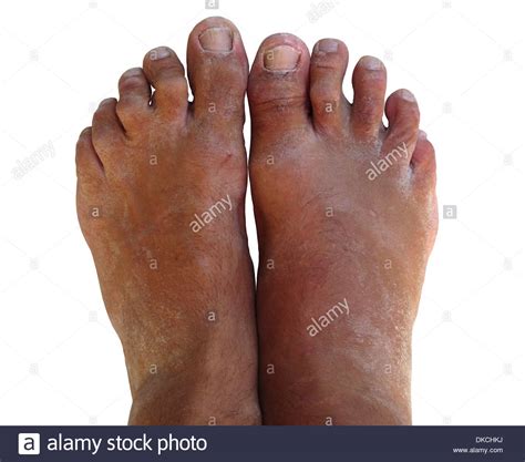 A Pair Of Bare Feet Looking Worse For Wear They Are Dry Scaly And