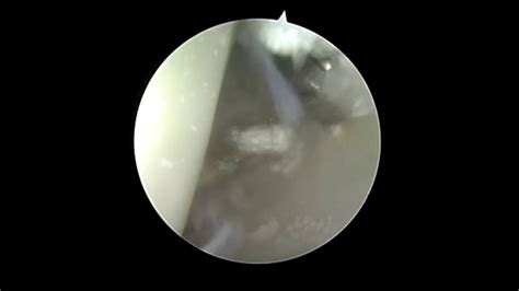 Arthroscopic Gout Removal Youtube