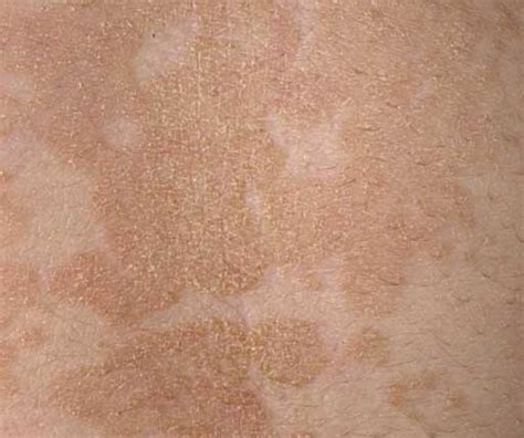 Tinea Versicolor African American Skin Pictures Photos