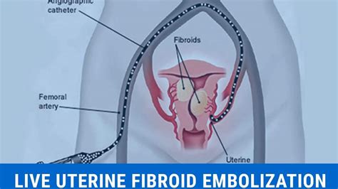 Watch A Live Uterine Fibroid Embolization In India A Non Surgical