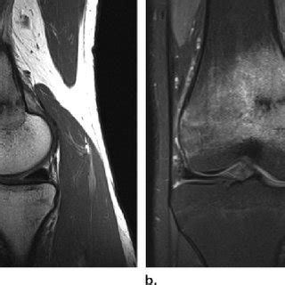 Gymnast's wrist: stress injury to the distal radial physis ...