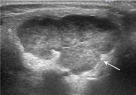 Imaging Evaluation Of Pediatric Parotid Gland Abnormalities Radiographics