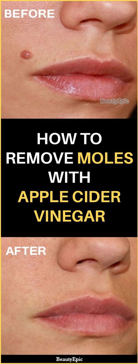 How To Remove A Mole With Apple Cider Vinegar Mole Removal Skin