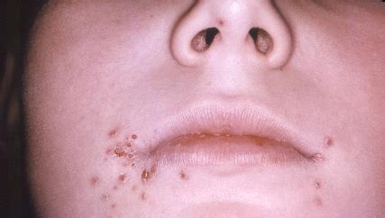 Herpes (herpes simplex virus of hsv) is a virus — just like any ol' virus such as the flu or a common cold. Evaluation of vesicular-bullous rash - Images | BMJ Best Practice