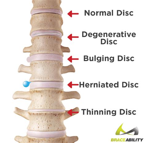 Symptoms Of Bulging Disc In Mid Back Doctorvisit