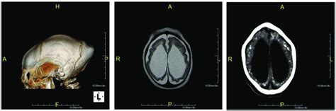 Neuroimage Findings In Infants With Congenital Zika Syndrome Czs 3d