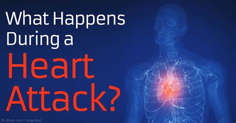 Curiosity 32 What Happens During A Heart Attack — Steemit