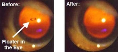 Maybe you would like to learn more about one of these? How to Get Rid of Eye Floaters without Surgery ( Also ...
