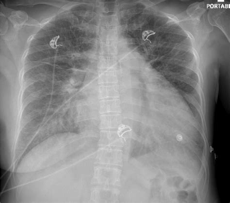 Chest Radiography Cxr Showing Pulmonary Vascular Congestion And
