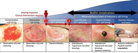 The Wound Infection Continuum Wound Infections Develop And Progress As
