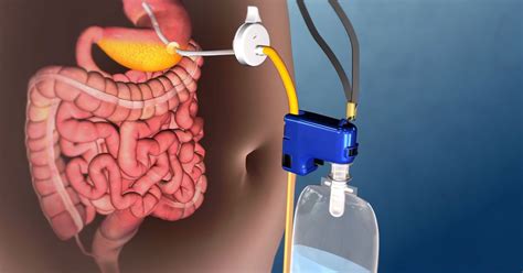 FDA Approves Stomach Pumping Machine For Obesity Science Of Us