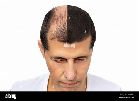 Man Before And After Hair Loss Treatment On White Background Stock