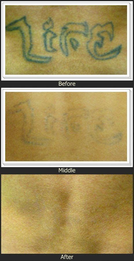 Removing A Tattoo How Much Does Tattoo Removal Cost Tatto Remove