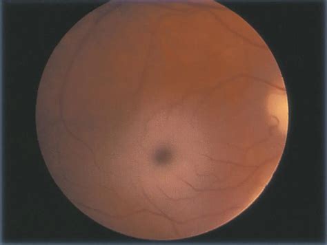 Cherry Red Spot Of Tay Sachs Disease American Academy Of Ophthalmology