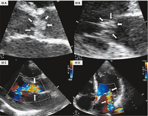 Transthoracic Echocardiography Tte Parasternal Long Axis View With Download Scientific