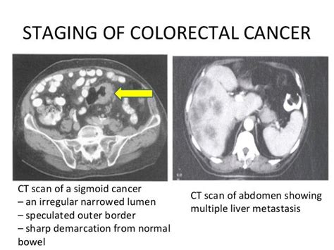 Colorectal Cancer Ct Scan