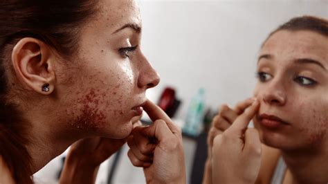 Acne Can Affect Your Mental Health But There Is A Lot Of Help Out There Huffpost Canada Life