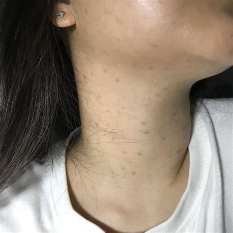 Skin Concern How Do I Get Rid Of This I Dont Have Neck Pimples