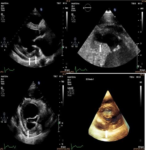 Multi Modality Imaging Of A Case Of Multiple Intra Cardiac Aneurysms