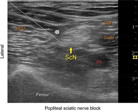 Ultrasound Guided Popliteal Sciatic Block Hadzics Peripheral Nerve