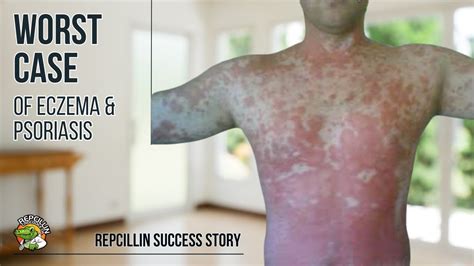 Worst Case Of Severe Eczema Psoriasis Repcillin Treatment Youtube