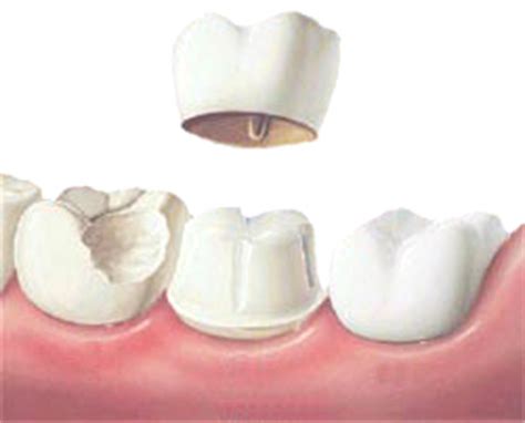 Dental Crowns - Coconut Creek Dentist