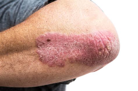 More Severe Psoriasis Is Linked With More Progression To Psoriatic