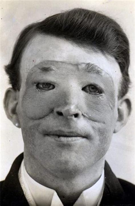Pictures Of First World War Soldier Undergoing Skin Graft