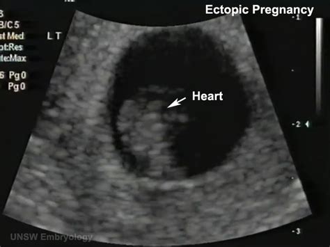 Fileectopic 01 Heart Embryology