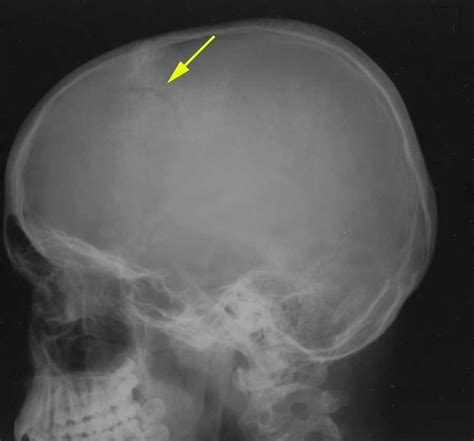 Depressed Skull Fracture On X Ray X Rays Case Studies Ctisus Ct