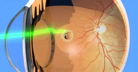 Eye Floaters And Flashes Of Light Linked To Retinal Tear Detachment