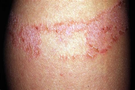 Contact Dermatitis Symptoms Rash And Treatment