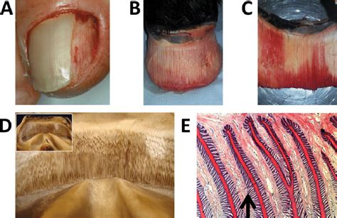 Anatomy Of Nail And Hoof Adhesion A Avulsion Of The Human Nail