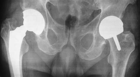 Hip Resurfacing Still A Highly Compelling Option For The Younger